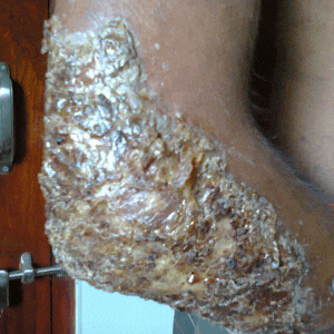Atopic dermatitis treatment